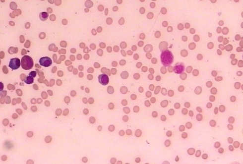 遗传性椭圆形红细胞增多症危险吗，如何治疗遗传性椭圆形红细胞增多症