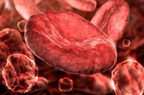 ​遗传性椭圆形红细胞增多症怎么治疗，药物治疗和输血治疗