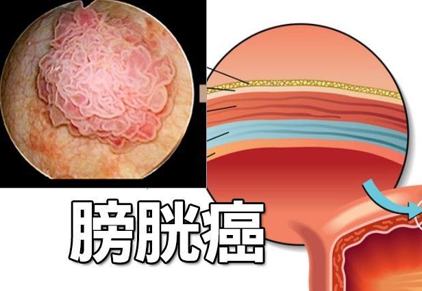 膀胱癌