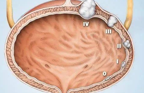 膀胱肿瘤结核的好发部位是，膀胱底部和壁面