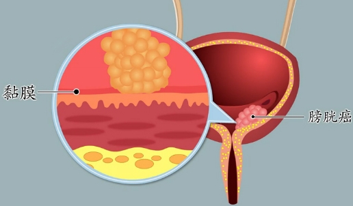 膀胱肿瘤