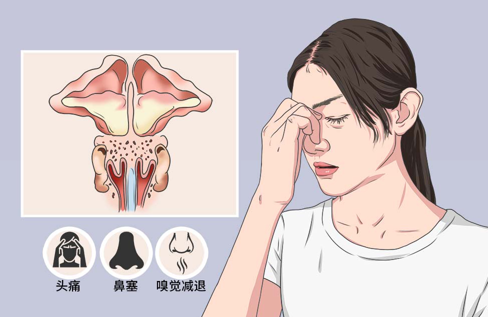 额窦炎的五大症状，鼻塞、鼻涕增多、面部疼痛等