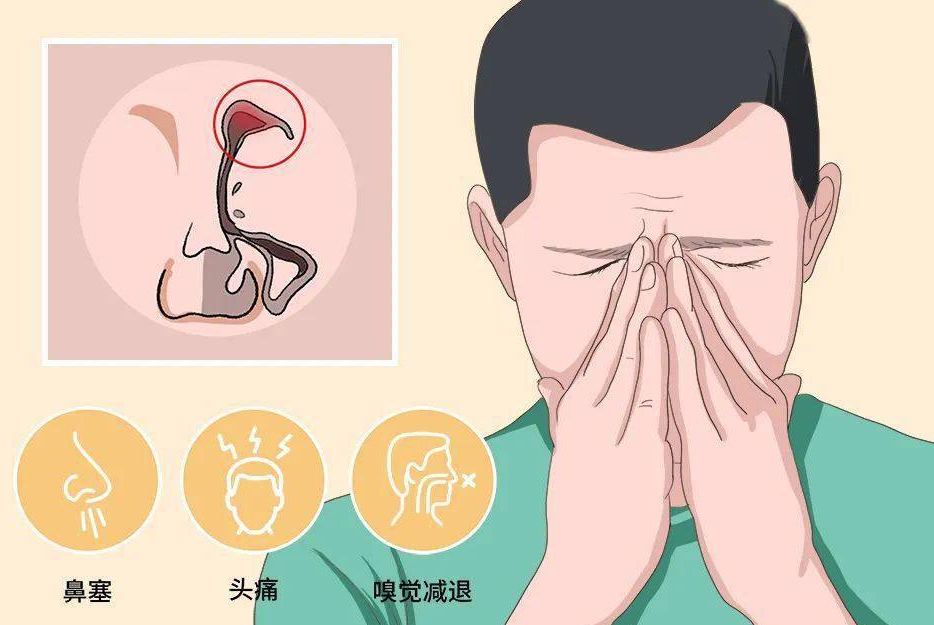 额窦炎症状表现有哪些？头痛、鼻塞、鼻涕及面部疼痛等