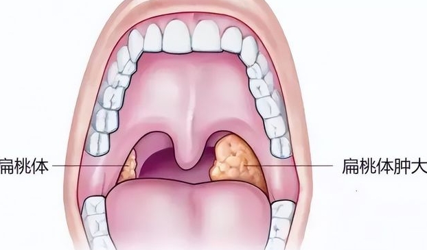 扁桃体癌