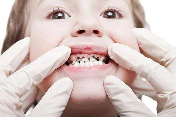 几岁儿童会换牙？