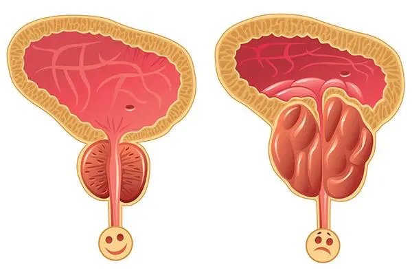 膀胱混合细胞癌能活多久？早期诊断治疗可提高生存率