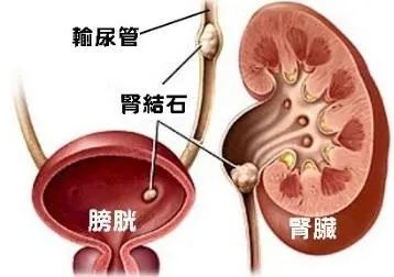 什么是膀胱尿道异物？各种异物，如石头、金属物和碎片等