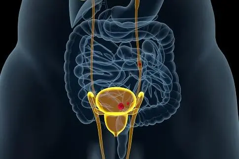 膀胱腺癌发现后多久会转移，发生转移取决于多个因素
