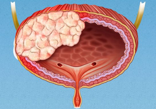 膀胱腺癌能活多久，早期发现和治疗可以提高生存率