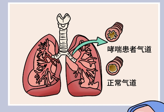 喘息性支气管炎吃什么药，氨茶碱/糖皮质激素/支气管舒张剂