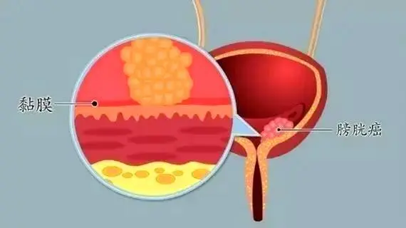 膀胱炎怎么引起的，引发膀胱炎的六大因素