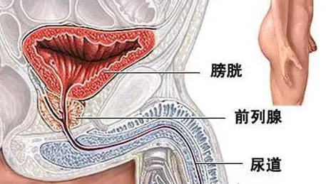 膀胱异物可以尿出来么，无法通过普通排尿将其完全排出