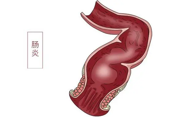 肠炎的症状及治疗方法，腹泻、腹痛、呕吐和发热等