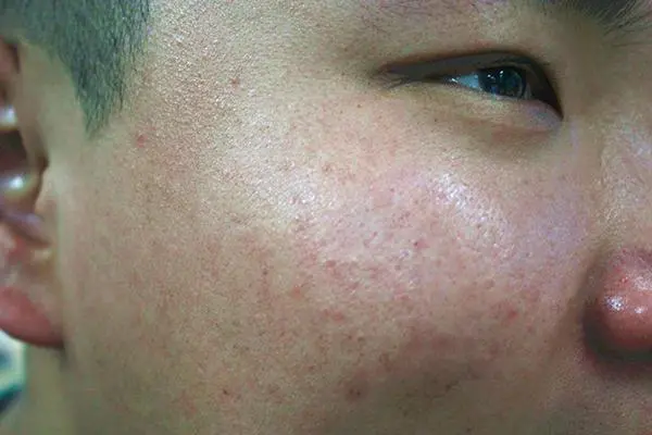 ﻿红斑狼疮是什么症状，同时出现红斑或皮疹/关节痛/发热多个症状