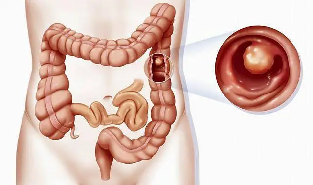 大肠息肉吃什么药可以消除？四种药物可起到辅助作用