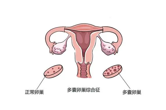 多囊卵巢综合症