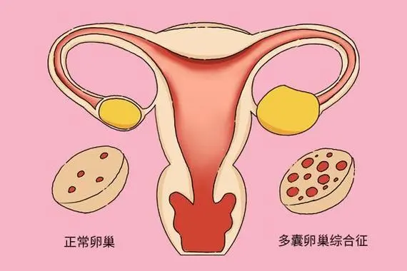 多囊卵巢综合症