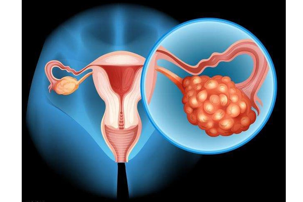 多囊卵巢综合症是什么原因造成的？能治好吗，遗传/肥胖/雄激素过多