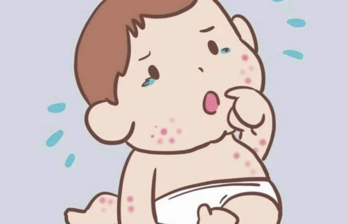 儿童过敏性荨麻疹
