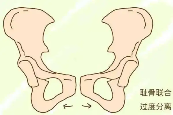 发育性髋脱位