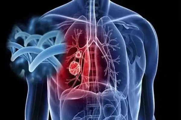 肺癌的早期症状和前兆，咳嗽加重/呼吸困难/胸痛
