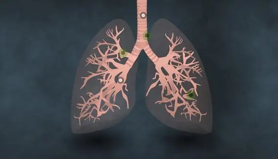 肺鳞癌最大的忌讳是什么，吸烟/不良饮食/不合理运动
