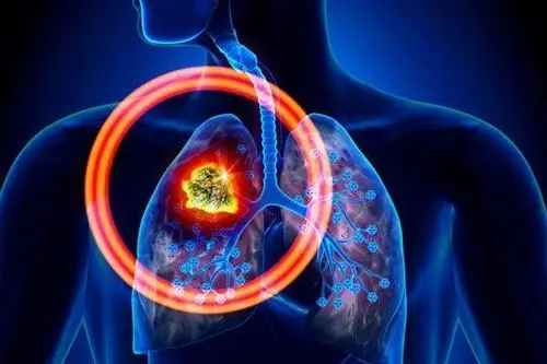肺部结节最怕三个征兆，分别是呼吸困难/持续性咳嗽/胸痛