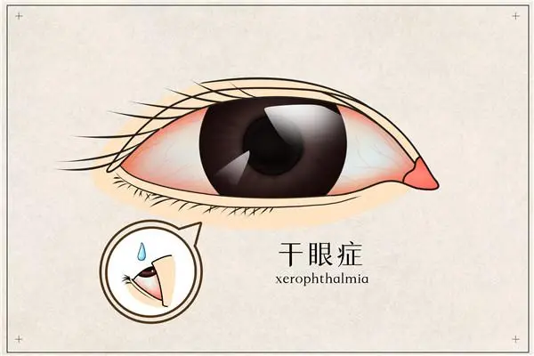 干眼症的症状表现，眼疲劳/眼部充血/视力模糊