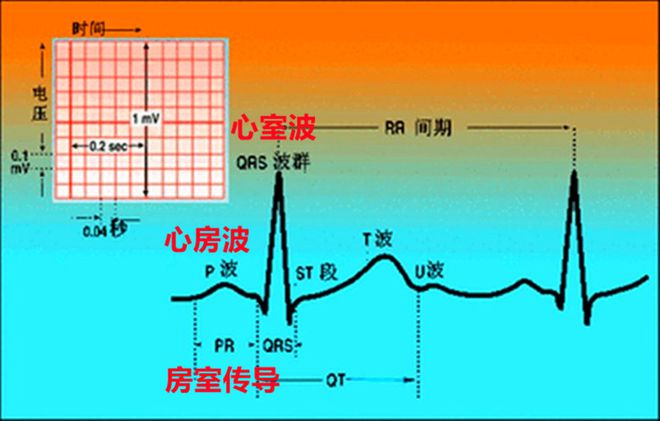 房室传导阻滞心电图特征，P波、T波和QRS波群等异常