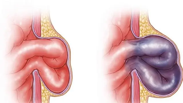 腹股沟疝气，腹股沟区域的肿块或疼痛