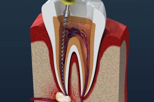 根管治疗