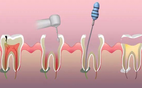 根管治疗