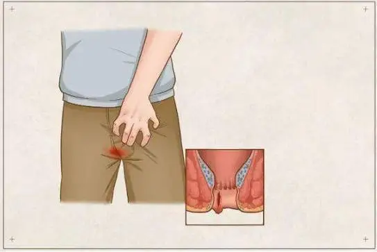 肛瘘是什么原因引起的，主要原因是肛周脓肿和肛管感染