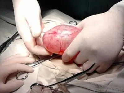 睾丸畸形瘤，男性睾丸中的罕见恶性肿瘤