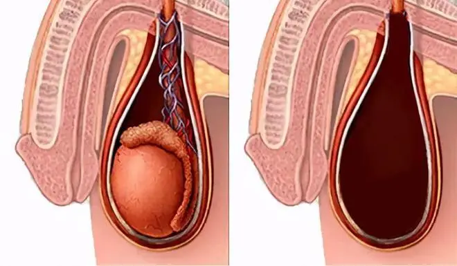 睾丸鞘膜积液症状表现