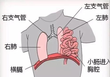 膈疝是什么意思，腹腔内的器官通过膈肌的缺陷进入胸腔