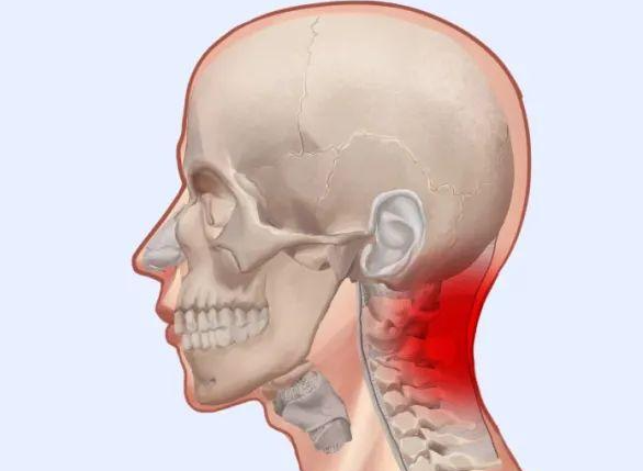 寰枢关节脱位的症状，颈部疼痛/颈部僵硬/头晕和眩晕等