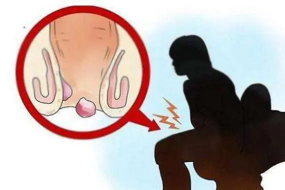 混合痔疮的症状表现有哪些，肛门瘙痒/疼痛和出血等