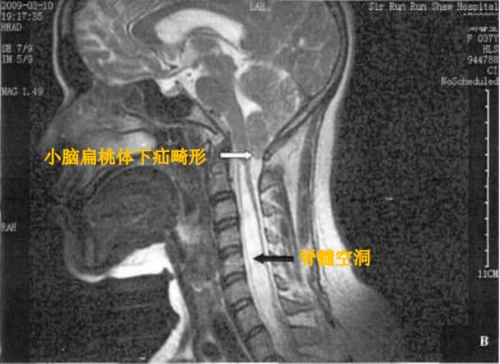 脊髓空洞症能活多久