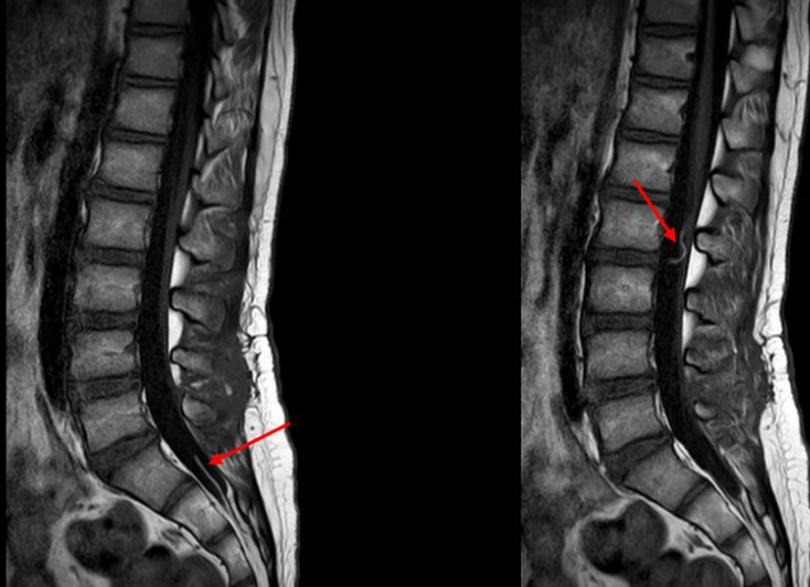 脊髓栓系综合征MRI表现