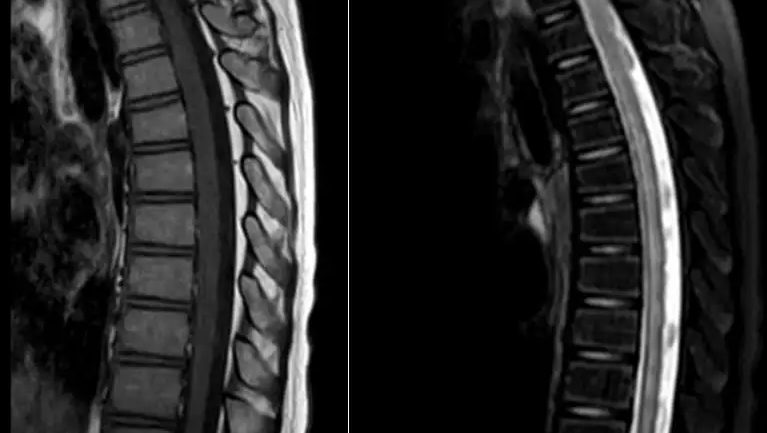 脊髓栓系综合征影像表现