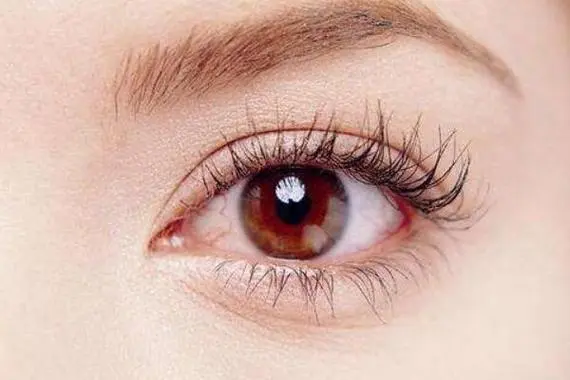 虹膜炎是怎么引起的，结核病和眼部创伤