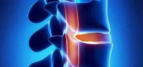 脊柱裂什么原因造成的，胚胎期脊柱发育异常引起的