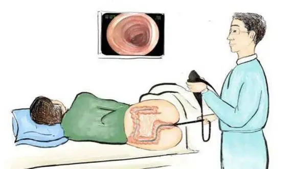 结肠息肉鉴别诊断，结肠镜/影像学和病理检查