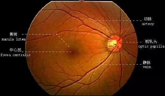 黄斑裂孔的症状，视力模糊/视物扭曲/低对比度