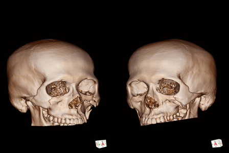 开放性颅脑损伤是什么意思，颅骨骨折伴有头皮破裂