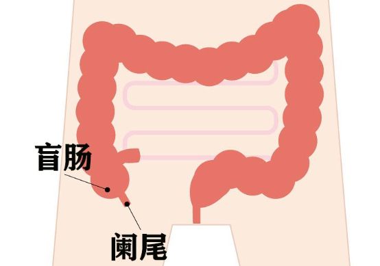 阑尾炎手术费用大概多少钱