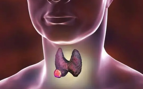 甲状腺癌的早期症状，肿块/喉咙不适/吞咽困难
