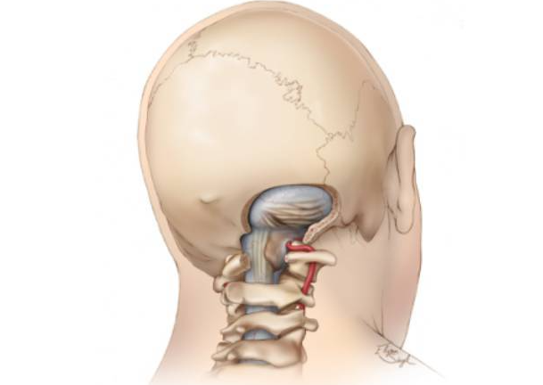 颅颈交界区畸形，颅骨和颈椎之间的接触处异常
