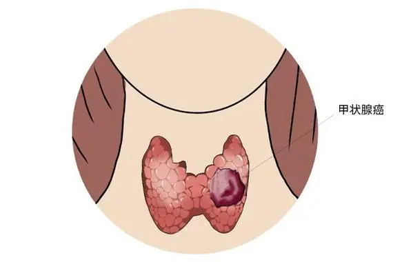 甲状腺肿瘤4b级严重吗，是甲状腺肿瘤中的严重阶段